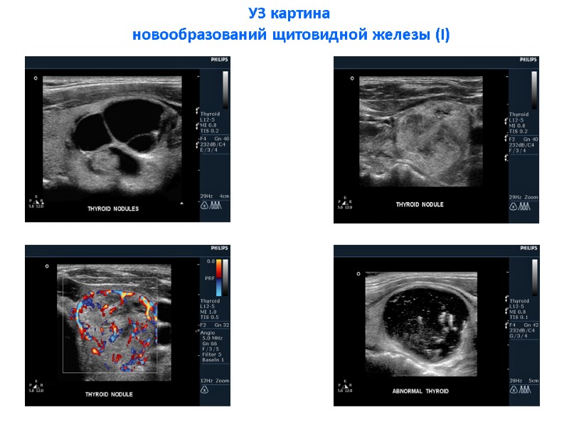 УЗ картина  новообразований щитовидной железы (I)
